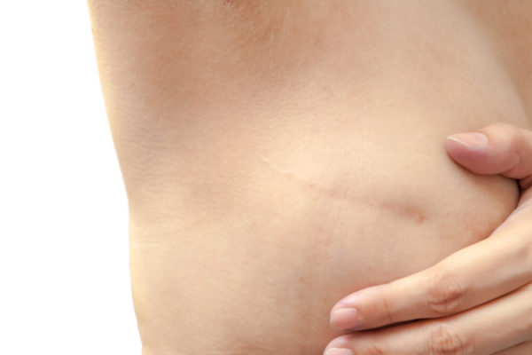 advantages-of-skin-sparing-mastectomy-advanced-surgical-physicians