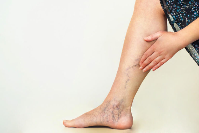 9 Ways To Stop Varicose Veins From Getting Worse | Advanced Surgical ...