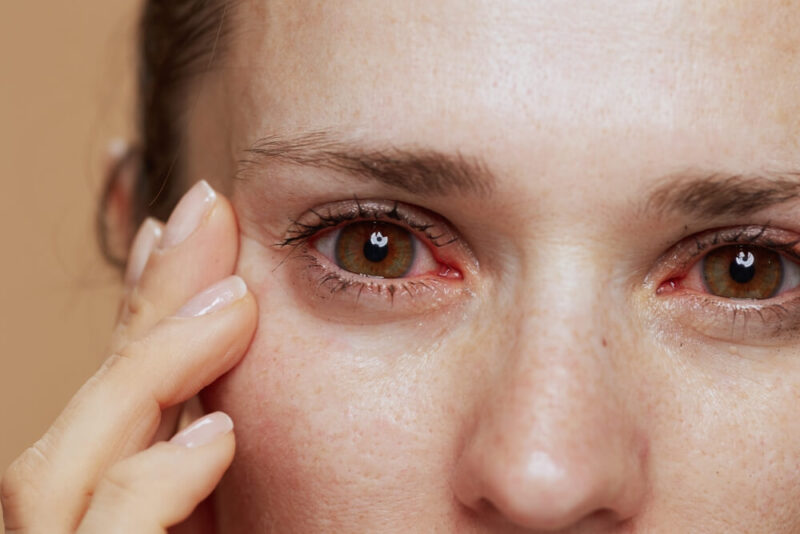 eye-allergies-most-common-reasons-for-itchy-red-eyes-allergy