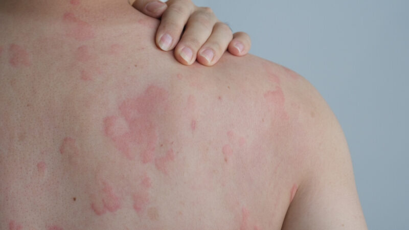 What are hives and symptoms of hives | Allergy & Immunology Center