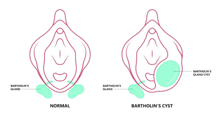 bartholin-s-cyst-causes-symptoms-and-removal-andrew-krinsky-md-facog