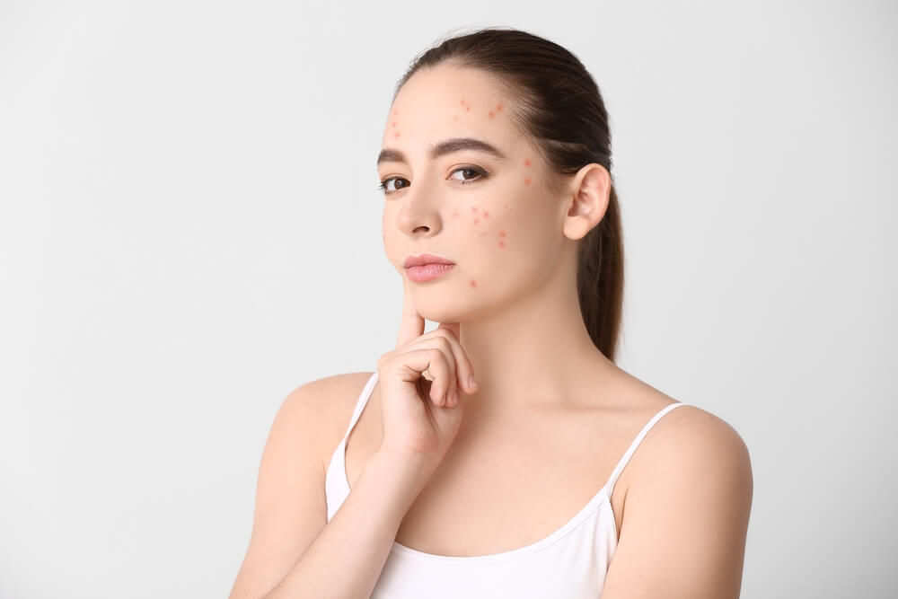 PCOS Acne How To Understand The Connection And Finding Solutions 