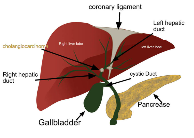 What is Cholangiocarcinoma and How It’s Diagnosed? | Omar Rashid ...