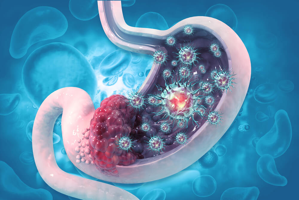 How To Detect Stomach Cancer 11 Early Signs Of Gastric Cancer Omar 