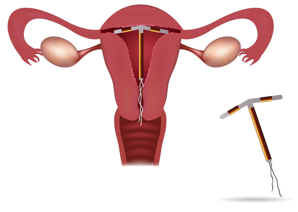 IUD Everything You Need To Know Trogolo Obstetrics And Gynecology 