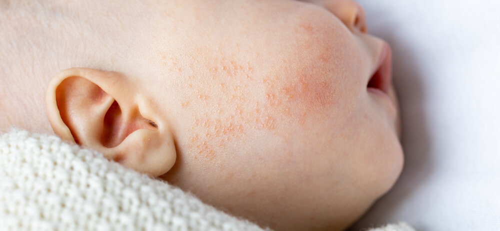 Baby Acne Why Do Newborns Get Pimples And How To Get Rid Of Them 